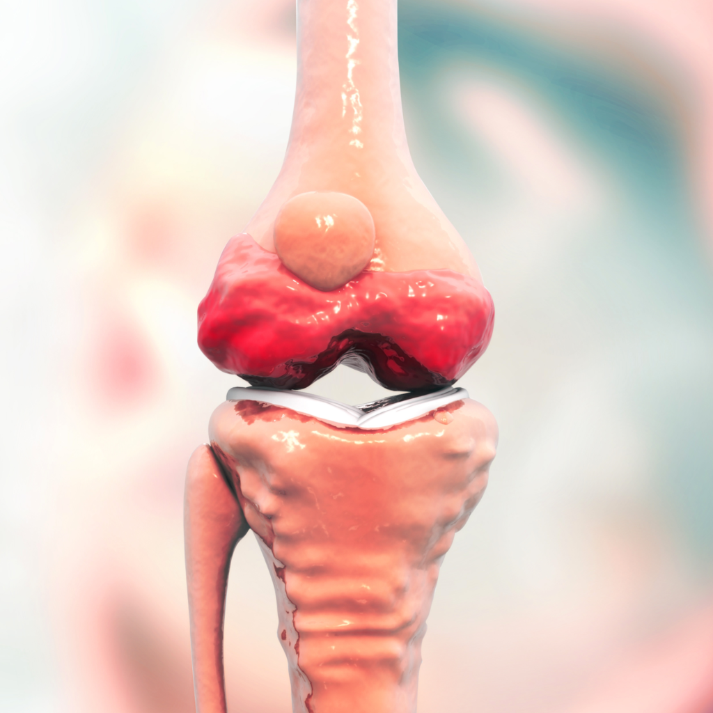 TRATAMENTO E PREVENÇÃO DA OSTEOARTRITE